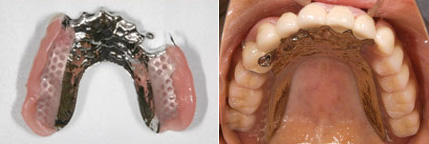 特殊な部分入れ歯